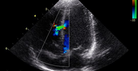L’échocardiographie transthoracique